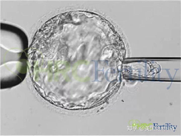 你的梦想可以成真--柳州双胞胎借卵试管受精技术