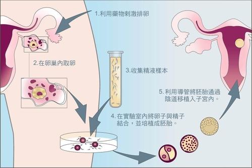 做试管婴儿需要什么检查