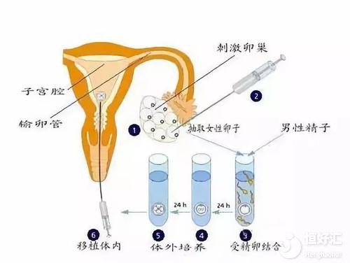 试管婴儿移植双胞胎有多少风险